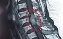 Cứu cụ bà 72 tuổi mắc khối u hiếm gặp