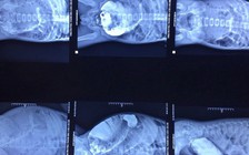 Bác sĩ sốc khi thấy bụng bệnh nhi ứ đọng 3 kg phân