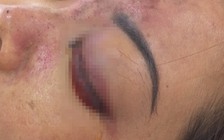 Người phụ nữ tiêm filler xong thì... mù mắt: Kiểm tra đột xuất cơ sở spa