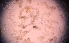 Cụ ông nhiễm giun lươn lâu ngày nhưng không được phát hiện