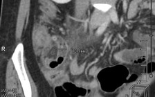 Vào viện do viêm ruột thừa, nhưng suýt chết vì bệnh tim