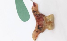 Phải làm gì nếu chẳng may nuốt phải răng giả, tăm tre...?