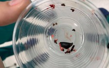 Bé trai nguy kịch do nuốt phải hạt sa pô chê