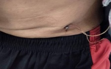 Giắt đinh ở lưng quần, ông thợ hồ bị đinh đâm xuyên thành bụng tới ổ bụng