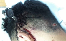 Nam sinh đi cấp cứu với chiếc chìa khóa xe cắm... vào đầu