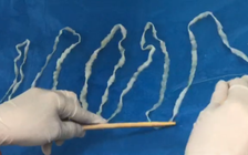 Lấy con sán dài 5,2 mét cho bệnh nhân nữ