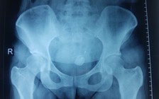 Lấy vòng tránh thai 'đi lạc' vào bàng quang, ổ bụng