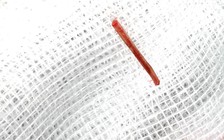 Thủng ruột nhưng được chẩn đoán, điều trị rối loạn tiêu hóa