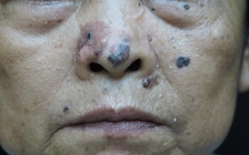 Bệnh ung thư da ngày càng gia tăng