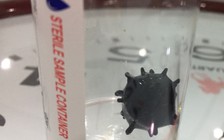 Vĩnh Long: Lấy ra viên sỏi mật to 2 cm có hình... virus Corona