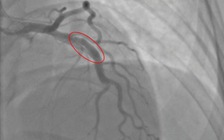 Cứu sản phụ sau sinh bị bóc tách động mạch vành