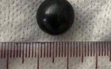 Bé trai nuốt viên bi sắt phải chuyển viện lên TP.HCM cấp cứu