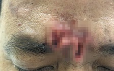 Bệnh nhân lấy nhíp 'đào bới' cơ thể tìm ký sinh trùng gây lở loét