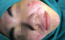 Chàng trai kể: Cả nhóm mua silicon ‘xách tay’ về tự tiêm để 'làm đẹp'