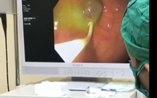 Cấp cứu bé 24 tháng tuổi bị kẹt hạt xí muội ở thực quản