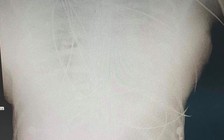 Nữ bệnh nhân trẻ tử vong sau 2 ngày nhập viện, trước đó có tiêm filler