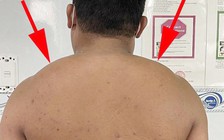 Người thường xuyên uống bia rượu có nguy cơ mắc bướu 2 bên cổ