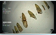 TP.HCM: Người đàn ông tự nuốt vào bụng 7 chiếc răng