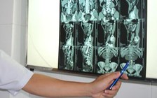 Bệnh thận móng ngựa thường có triệu chứng gì?