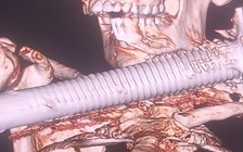 Nam công nhân ngã giàn giáo bị thanh sắt xuyên cổ nguy kịch