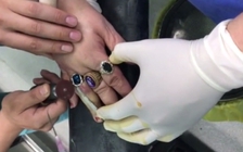 Suýt mất ngón tay vì đeo nhẫn