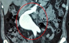 Cứu bệnh nhân có động mạch chủ bụng to bằng quả bưởi suýt vỡ