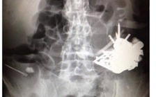 Lấy ra hơn 100 miếng kim loại từ dạ dày bệnh nhân