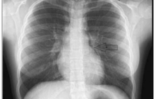 Gào thét dữ dội khi xem thần tượng biểu diễn rồi... nhập viện cấp cứu