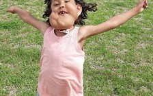 Những người mắc bệnh lạ: Sống vui vẻ trước sự nhạo cười của người đời