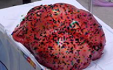 Cắt bỏ khối u dạ dày 19 kg để cứu cụ bà 'ngàn cân treo sợi tóc'