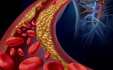 Bổ sung vitamin D giúp động mạch khỏe hơn