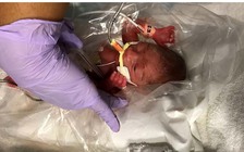 Sức sống mãnh liệt của một cậu bé sinh non