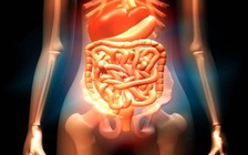 Soi ruột kết làm tăng nguy cơ viêm ruột thừa