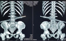 Cụ ông trượt ngã bị cọc sắt đâm thủng bụng