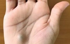 Nốt đỏ nhỏ trong lòng bàn tay 'tố cáo' điều gì?