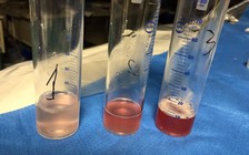 BV Nhi đồng 2 cứu bé gái mắc bệnh hiếm gặp, thế giới mới có 500 ca