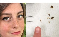 Một phụ nữ bị con gián chui vào lỗ tai và mắc kẹt ở đó 9 ngày