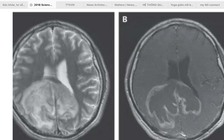 Phát hiện ký sinh trùng 'thức dậy' trong não một người đàn ông