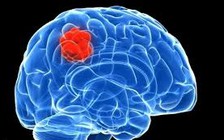 Những dấu hiệu cảnh báo khối u não bạn nên biết