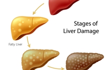 Chớ chủ quan khi bị gan nhiễm mỡ!