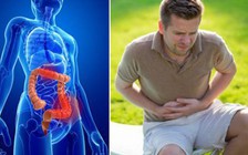 5 dấu hiệu 'tố cáo' bạn có thể bị ung thư đại tràng