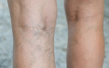 Thấy những vằn mạch máu xanh tím nổi trên da, hãy đi khám tim ngay!