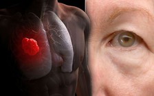 Gặp hiện tượng lạ này ở mắt, đi khám ung thư phổi ngay!