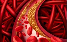 Màu ngón chân tiết lộ nồng độ cholesterol cao