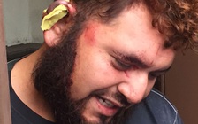 Bị bạn cắn đứt tai vì tranh cãi chính sách nhập cư của ông Trump