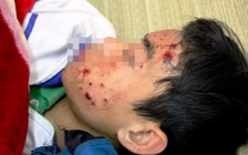 Điện thoại phát nổ khi đang sạc pin, 1 người bị thương