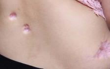 Cô gái 18 tuổi bị teo da sau khi tiêm thuốc điều trị sẹo tại mỹ viện