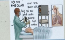 Bệnh viện Bạch Mai công bố lý do bệnh nhân tử vong khi nội soi phế quản