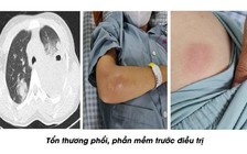 Bộ Y tế đề nghị tăng nguồn cung ô xy cho điều trị Covid-19