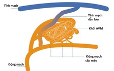 Phát hiện 'đám rối' mạch máu gây nhồi máu não